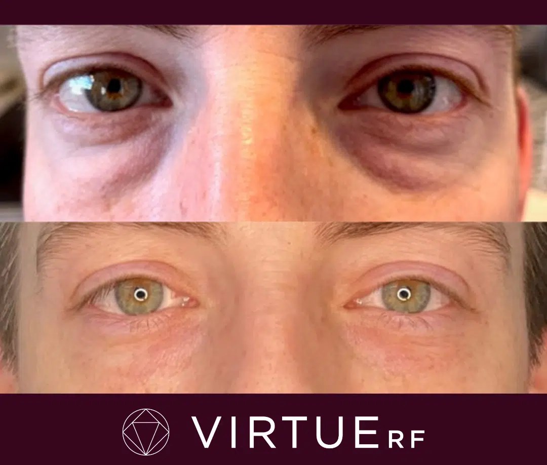 Contour des yeux d'une femme présentant des poches sous les paupières inférieures