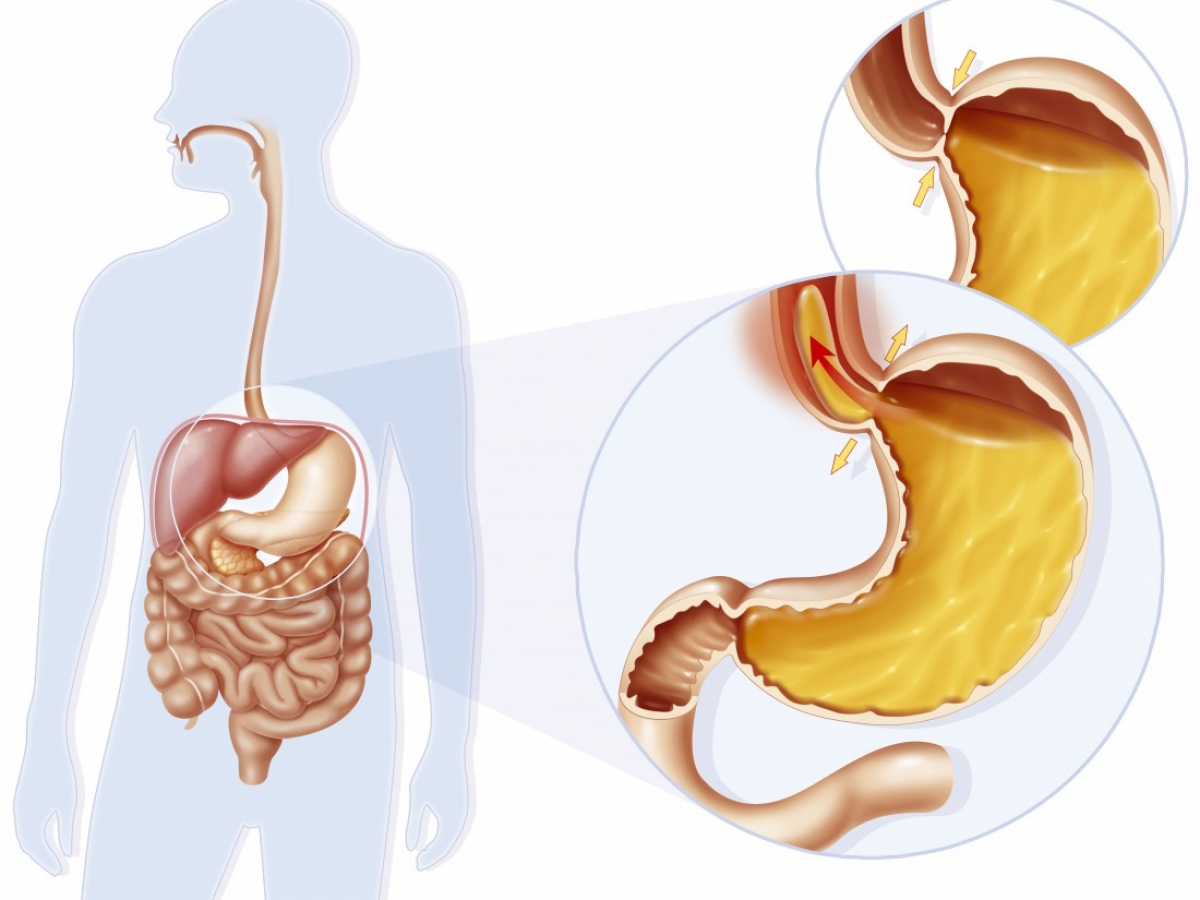 Personne portant la main à la poitrine à cause d'une brûlure liée au reflux gastrique